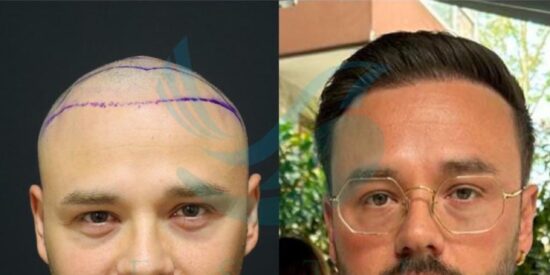 trasplante capilar en Turquía